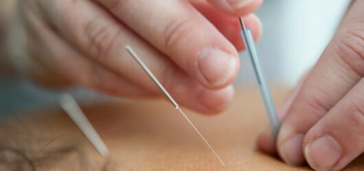 Hva er dry needling – og hva kan behandlingen brukes til?