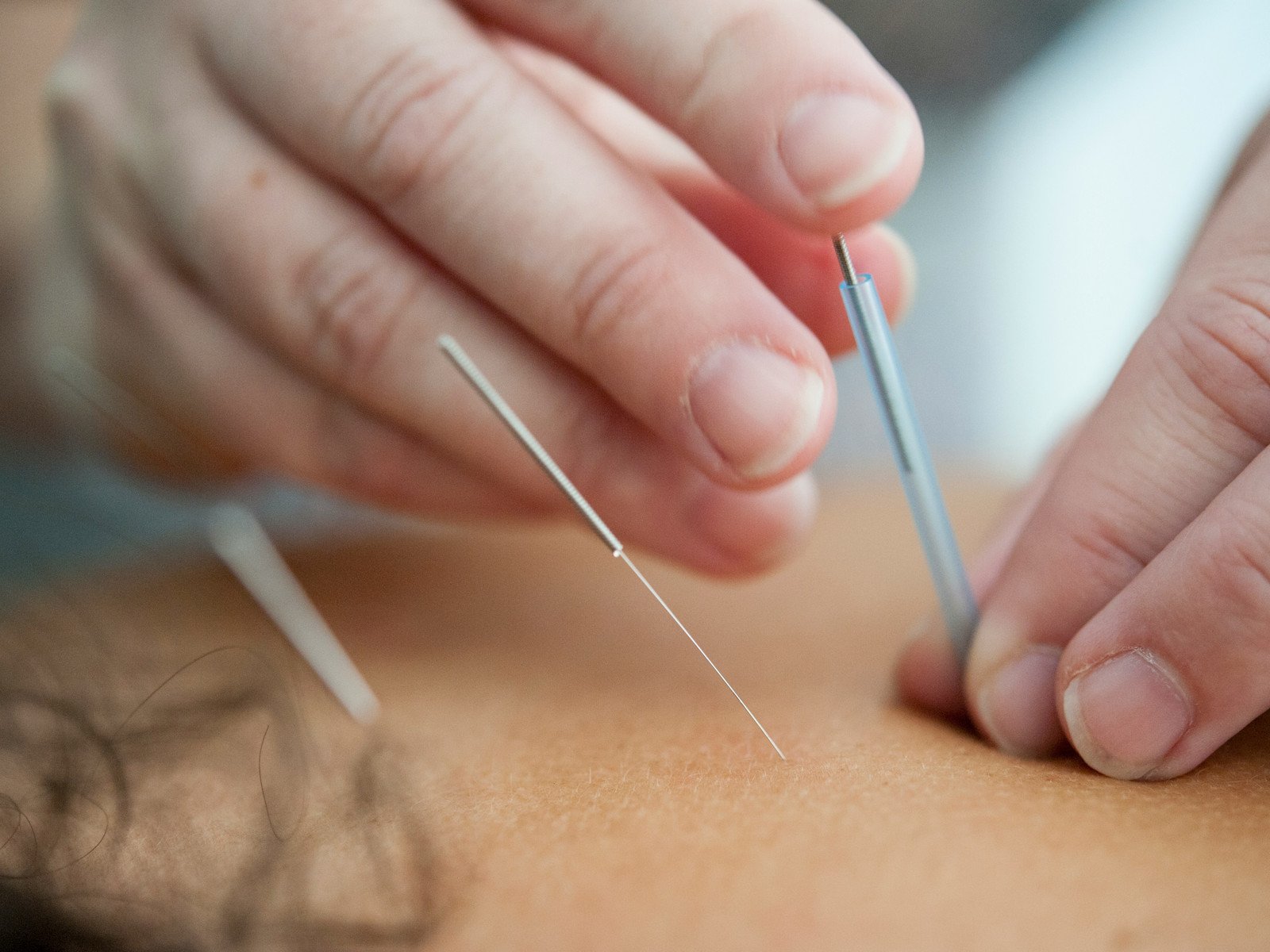 Hva er dry needling – og hva kan behandlingen brukes til?